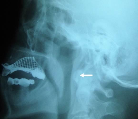 Yapılan radyolojik incelemede lateral servikal direkt grafide C1-C2 arasında vertebra korpus anteriorunda belirgin olan osteofitik ve