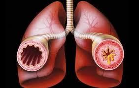 Ventilasyonu imkansız kılan, malign bir tablodur. Genelde altta yatan bir pulmoner hastalık rol oynayabilir.