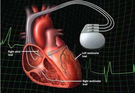 Kardiyak Resenkronizasyon Tedavisi Kalp Yetersizliği (Sınıf I) Optimal tedaviye rağmen NYHA III-IV, LVEF <35%, LV diyastol sonu çapı >55 mm Geniş