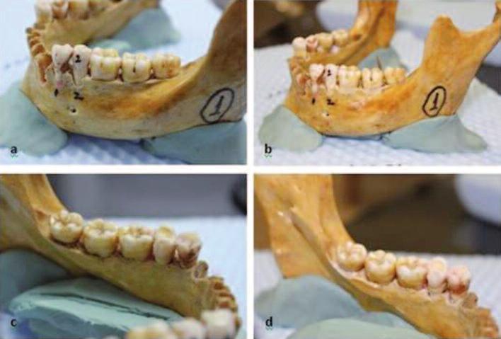 RESİM 1: a) Molar bölgede sağlıklı bukkal kemik görünümü; b) Molar bölgede bukkal kemikte 2 mm derinlikteki kemik defektleri görünümü; c) Premolar bölgede sağlıklı bukkal kemik görünümü; d) Premolar