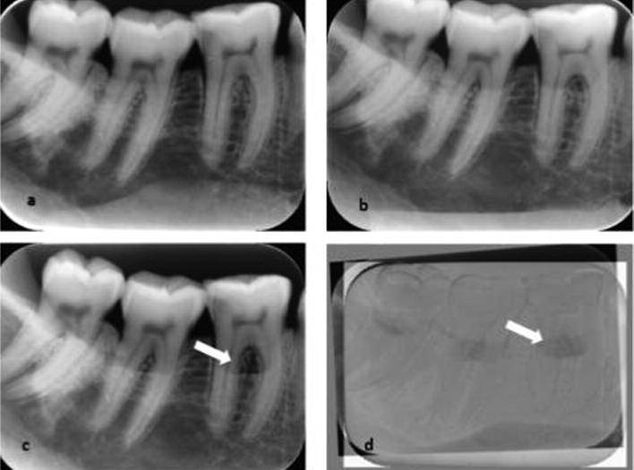 RESİM 2: a) Sağlıklı molar bölgeden fosfor plak ile alınan periapikal radyografi; b) 2 mm lik defektli bölgeden fosfor plak ile alınan periapikal radyografi; c) 4 mm lik defektli bölgeden fosfor plak