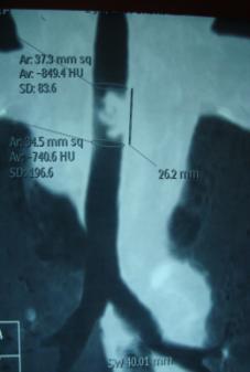 Endobronşiyal tedavi yöntemleri ENDOLÜMİNAL Hızlı Yöntem Debulking Lazer Elektrokoter APC 1 Wahidi MM. Chest 2007;131:261-274 2 Herth FJ.