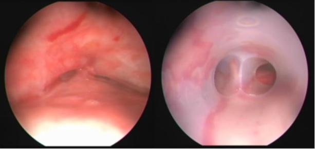 OLGU Our Experience on Silicone Y-Stent for Severe COPD Complicated With