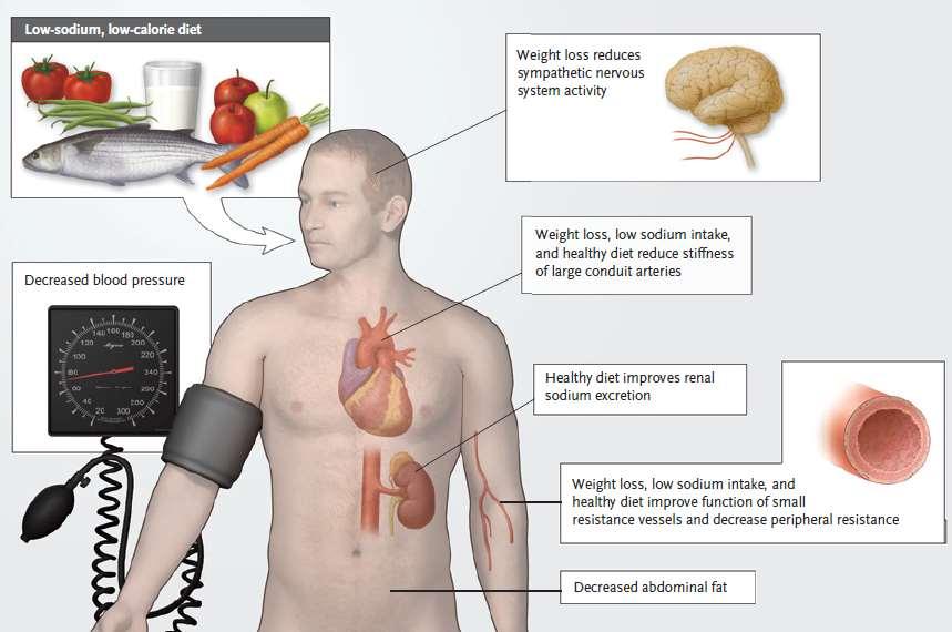 Yaşam Tarzı Değişiklikleri ve Metabolizma Düşük sodyum, düşük kalorili diet Kilo verme ile sempatik aktivitede azalma Düşük kan basıncı