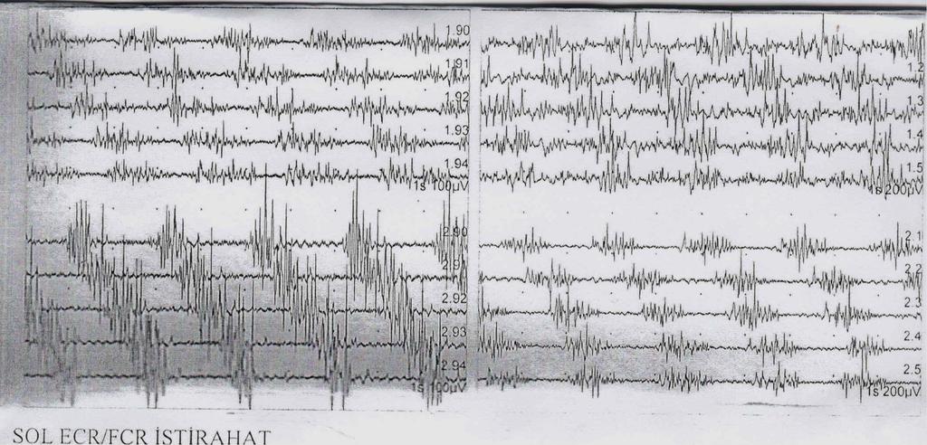 39 4.3. EMG Tremor Kaydı Sonuçları Bu çalışmada 5 ET, 5PH, 5 ET-PH hastasına tremor kaydı yapılabildi.