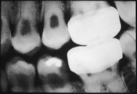 Tip II Dentin Displazisi:Daimi dişlerde