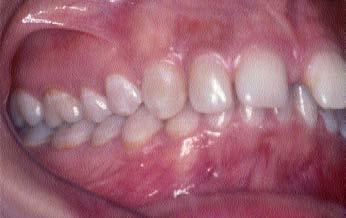 . Figure 1: Pretreatment extraoral and intraoral photographs and panoramic radiograph.