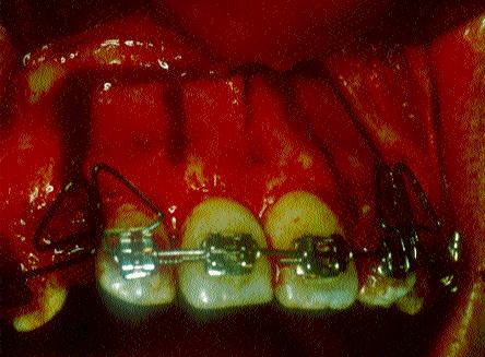 Subapikal Kortikotomi Subapical Corticotomy Post-surgical orthodontics Immediately after the surg e r y, maxillary retfiekil 2: Cerrahi ifllem. Figure 2: Surgical procedure. 0.016x0.