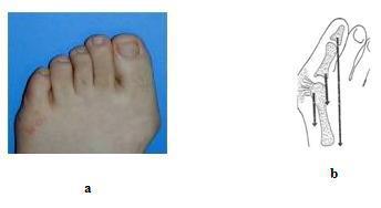 Parmak fırlaması Ayak Parmaklarında Bükülme Çekiç Parmak Orta eklem (PIP) bükülmüş, uç eklem (DIP) gergin, dip eklemse (MTP) normal ya da aşırı gergin olabilir (Şekil 1. 14).