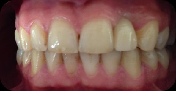 performed by composite finishing burs (Mani, Diascholarship, Tokyo, Japan) and composite polishing discs (Sof-Lex, 3M-ESPE, St. Paul, USA) (Figure 2).