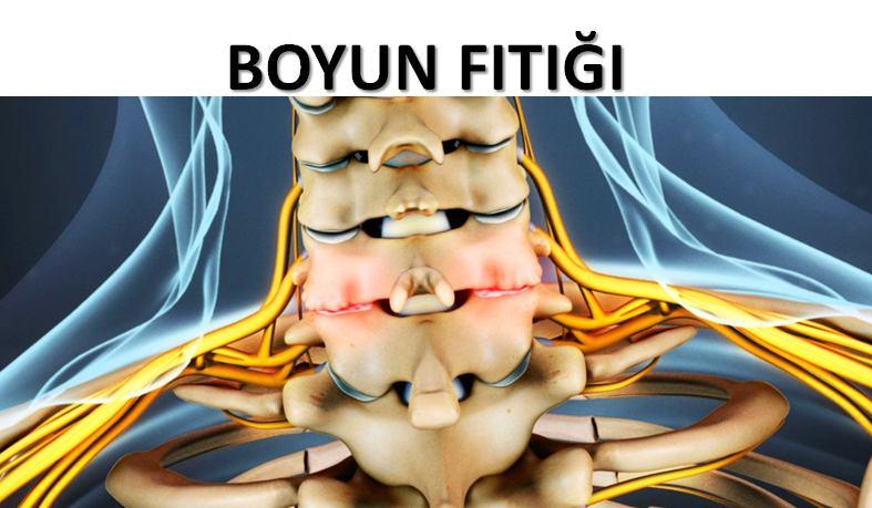 BOYUN FITIĞI Boyun fıtığı, boyun omurlarının arasındaki kıkırdağın, omurilik kanalına doğru yer değiştirmesi veya çıkması sonucu, kola gelen sinirlere ve omuriliğe baskı yapması ile oluşan hastalığa