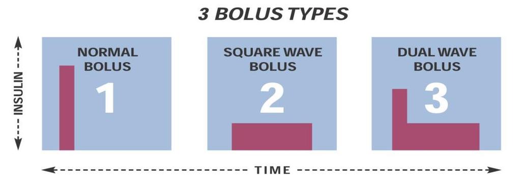 Bolus Tipleri NORMAL BOLUS YAYMA BOLUS (KARE DALGA BOLUS) İKİLİ