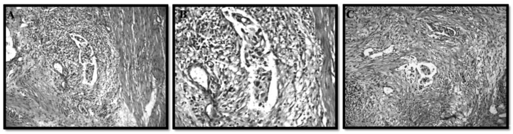 Yanaral ve Şengör Mesane tümörlerinde lenfovasküler invazyonun önemi Şekil 1: Hematoksilen eozin boyalı kesitlerde LVİ görüntüsü (A, C 200 büyütme, B 400 büyütme) 8 inde LVİ gözlenmedi.