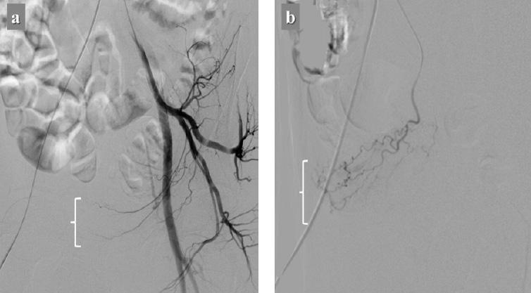 Yeni Üroloji Dergisi - The New Journal of Urology 2018; 13 (3): 54-57 Figure 2: a. Branches of left superior vesical artery. b. Right superior vesical artery and bleeding location in the bladder.