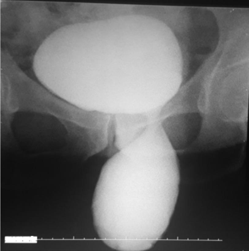 Yeni Üroloji Dergisi - The New Journal of Urology 2018; 13 (3): 70-73 Figure 2: A 52 year-old man with left scrotal bladder hernia who had previous left inguinal hernia operation Figure 3: The