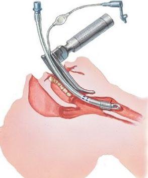 trakeaya bir tüp koymak ve solunum faaliyetini bu tüp yardımıyla yaptırmaktır. Orotrakeal (Ağızdan trakeaya) ya da Nazotrakeal (Burundan trakeaya) olmak üzere iki şekilde uygulanabilir.