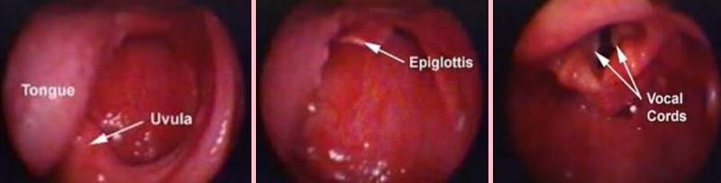 Entübasyon Tekniği Laringoskop sol elle tutulur. Ağzın sağ yanından girilerek, dil sola toplanmaya çalışılır. İlk amaç epiglotu bulmaktır.