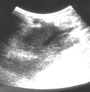 Ultrasonografi Eşliğinde Perkütan Toraks Biyopsileri / Ultrasound Guided Percutaneous Transthoracic Biopsies 67 A B Perkütan transtorasik biyopsilerde serbest el tekniği yalnızca büyük boyutlu ya da