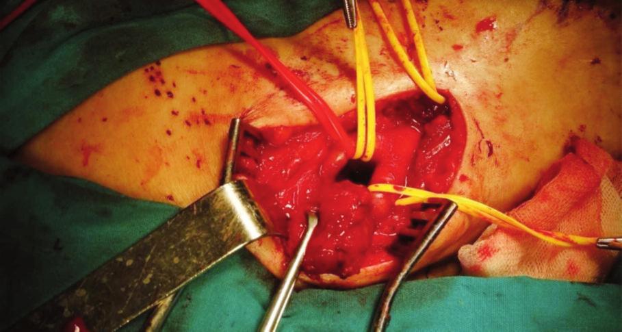 Rukiye Derin ATABEY ve ark. Turkiye Klinikleri J Med Sci 2018;38(3):293-7 algılayarak solunum ve kardiyovasküler sistemin otonomik kontrolünü sağlayan yapıya Karotid Cismi denir.