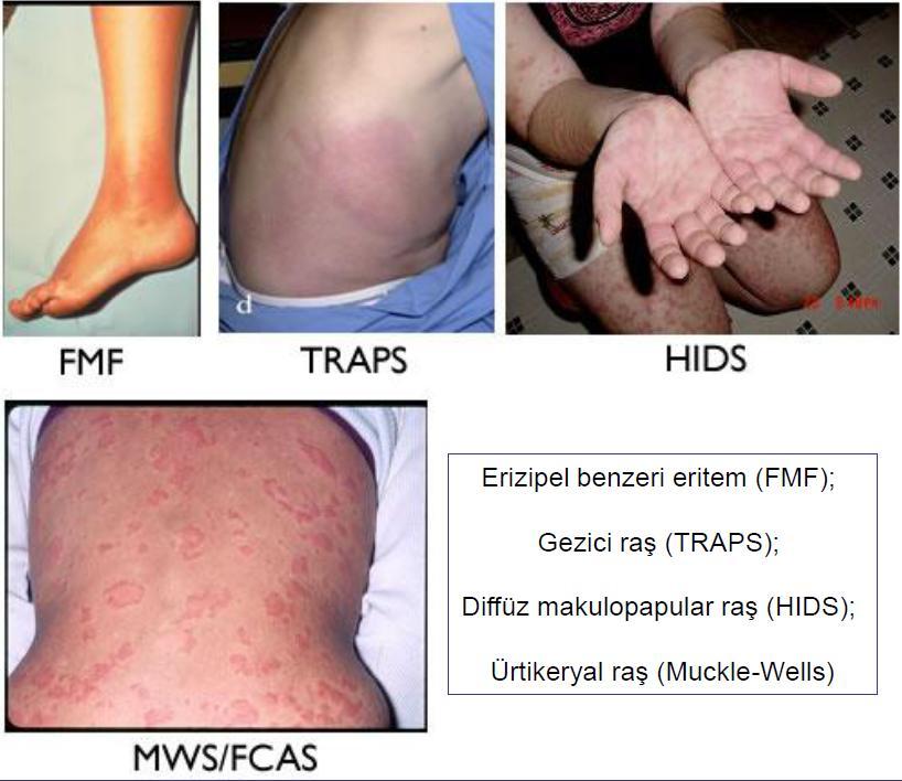 Tümör Nekrozis Faktör Reseptör İlişkili Periyodik Sendrom (TRAPS) veya ailesel Hibernian ateş 2-3 hafta süren tekrarlayan yüksek ateş atakları ile karakterize inflamatuar bir hastalıktır.