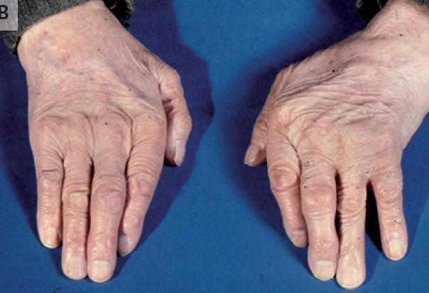 Asemptomatik Akut mono veya oligoartiküler başlangıç ---------- (%25) Gut, Septik artrit? Diz, el bileği sık 1.