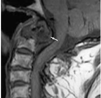 (daha az sıklık) Spinal (intervertebral disk, spinal ligaman) -