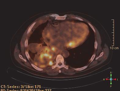 PET/CT incelemesinde sağ akciğer alt lob süperior segmentte malign karakterli kitle lezyonu Hastanın ilk gelişinde cilt lezyonu bulunmadığından tanı BT eşliğinde transtorasik