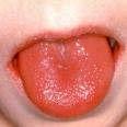 Kızıl, toplu yaşanılan alanlarda (okul, kışla, yuva gibi) daha yaygın olarak görülür. Kızıl (Scarlet fever, Scarlatina) Kızıl, döküntülü ve bakterilerin neden olduğu bir bulaşıcı bir hastalıktır.