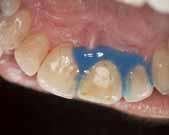 Beyazlatma başarısı doğal diş rengine ve renklenmenin yoğunluğuna göre değişmektedir Travma sonucu oluşmuş renklenmeler İlaç kullanımına bağlı oluşmuş olan renklenmeler (örn.
