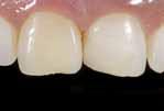 rekonstrüksiyonunda Renklenmiş anterior dişlerin maskelenmesinde Estetiğin düzeltilmesinde, renk ve şekil değişikliklerinde Dişlerin splintlenmesinde Veneerlerin tamir edilmesinde Süt dişi