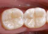 rekonstrüksiyonunda Renklenmiş ön dişlerin fasetlenmesinde Daha iyi estetik görünüm için şekil ve renk düzeltilmesinde Mobil dişlerin sabitlenmesinde Faset tamirinde, mine defektlerinde ve