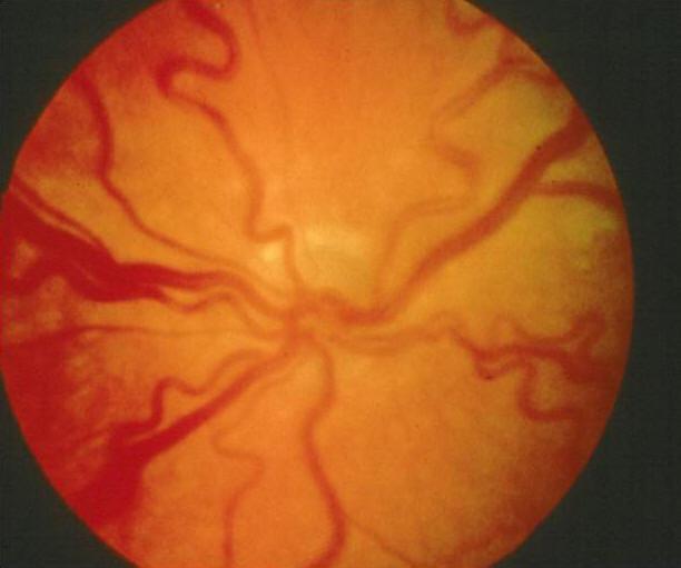 ROP-Plus Hastalık Arka kutupta retinal venöz