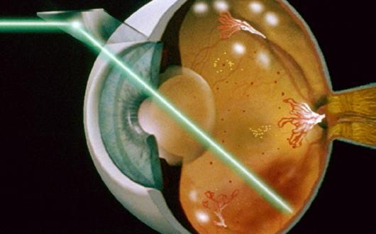 ROP-Tedavi Retinal ridge dokusunun önündeki periferik