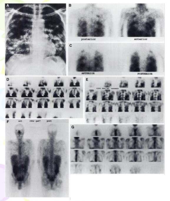 X-ray à(a) 201 Tlscan