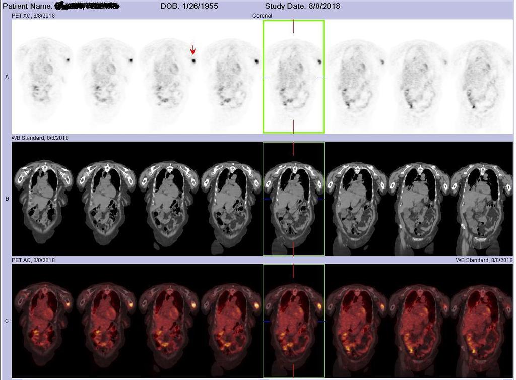 08/2018 PET-CT