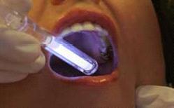 Amerika da 2001 yılında lisans alan bu yöntemi ilk uygulayan araştırmacılardan birisi olan Silverman Jr, oral mukozadaki anormal epitel hücelerinin aseto beyaz olarak tanımlanan beyaz renkli bir