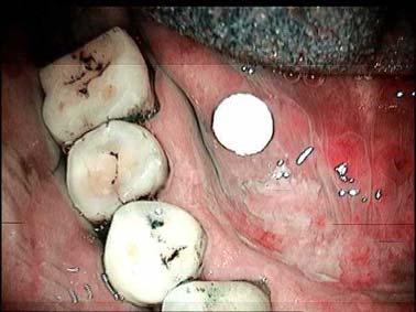 hiperkeratotik lezyon Şekil 29: Toluidin