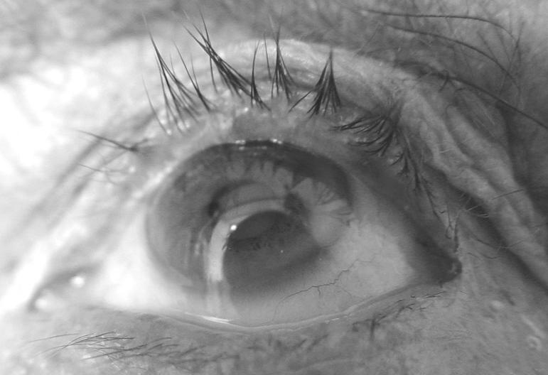Resim 3a. Olgu 1, sol göz. Ameliyat sonrası 22. ayda rekürrens izlenmiyor. Resim 3b. Olgu 2, sol göz. Dermatoşalazise bağlı yaygın trikiyazisi olan hastanın ameliyat sonrası 6. aydaki görünümü.