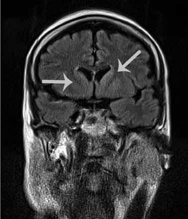 nükleusda sinyal artışı. Elektroensefalografi (EEG) fronto-sentral bölgelerde hakim, 0.5-1 sn de bir ortaya çıkan jeneralize bifazik/trifazik keskin dalgalardan oluşmaktadır (Şekil 1a).