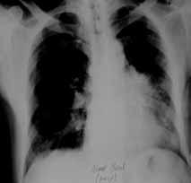 mammaria internadan, akci er parankiminin yaralanmas ndan, ana pulmoner damar veya dallar ndan, kalp veya kalbe giren yahut ç kan büyük damarlar n yaralanmalar ndan, herhangi bir intratorasik