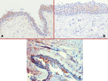 Ophthalmology Konuk et al FIGURE 1: Immunohistochemical analysis of COX-2 in (A) normal conjunctiva (B) primary pterygium, and (C) recurrent pterygium.