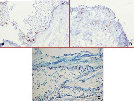 Konuk ve ark. Göz Hastalıkları FIGURE 2: Immunohistochemical analysis of Ki-67 in (A) normal conjunctiva (B) primary pterygium, and (C) recurrent pterygium.