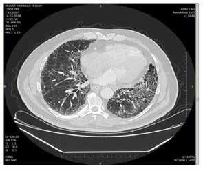 pulmoner fibrozis (İPF), olağan interstisyel pnömoninin (UIP) histopatolojik ve/veya radyolojik görünümü ile birliktelik gösterir (1-4).