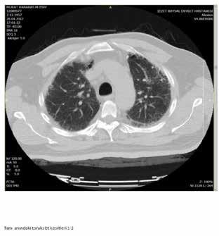 KAYNAKLAR 1. Lynch DA, Godwin JD, Safrin S, et al. High-resolution computed tomography in idiopathic pulmonary fibrosis: diagnosis and prognosis.