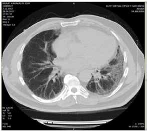 An official ATS/ERS/ JRS/ALAT statement: idiopathic pulmonary fibrosis: evidence-based guidelines for diagnosis and management. Am J Respir Crit Care Med 2011; 183: 788-824. 3.