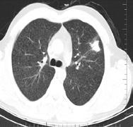 Subakut semptomları olan ve benzer radyolojiye sahip üç farklı hasta intersitisyel akciğer hastalığı olarak takip edildi.