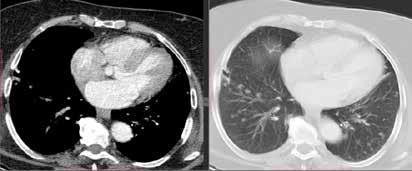 Pulmoner kalsifikasyon ve ossifikasyon, akciğer grafisi, bilgisayarlı tomografi ve kemik sintigrafisi gibi görüntülemeler gerektirir.