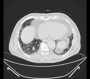 DİYOPATİK PULMONER FİBROZİS VE AKCİĞER KANSERİ BİRLİKTELİĞİ: OLGU SUNUMU Kadir Canoğlu 1, Oğuzhan Okutan 1, Gözde Kalbaran Kısmat 1, Ömer Ayten 1, Tayfun Çalışkan 1, Zafer Kartaloğlu 1 1 İstanbul