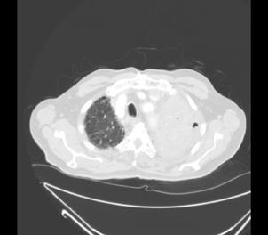 içerisinde en sık görülen türüdür. İPF, etyolojisi bilinmeyen, sağkalım süresinin tanıdan sonra 3-5 yıl civarında olduğu, kronik, ilerleyici fibrozis ile seyreden bir akciğer hastalığıdır.