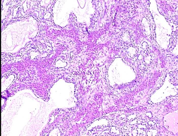Resim 1. Endodermal sinus tümöründe mikrokistik ve makrokistik patern izleniyor (Hematoksilen-Eozin x40). Resim 2.